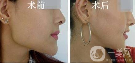 磨骨多少錢？磨骨價(jià)格盤點(diǎn)！