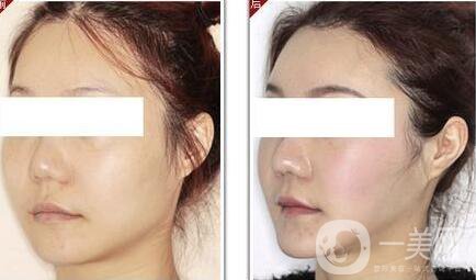 改臉型需要多少錢？