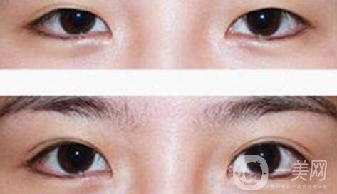 疤痕皮膚能割雙眼皮么 會有影響嗎