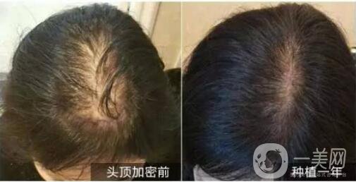 北京做植發(fā)手術(shù)哪里*果好？