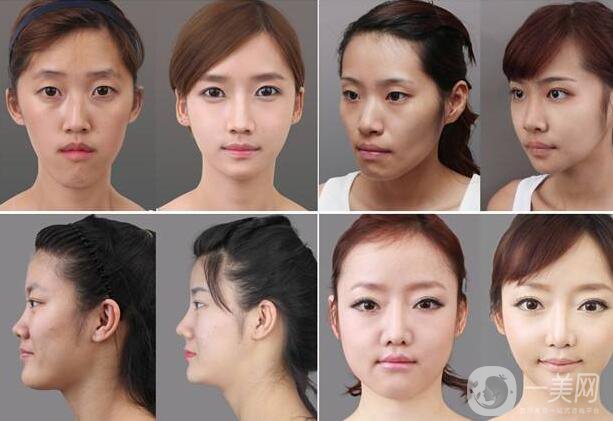 北京顴骨手術(shù)要多少錢？