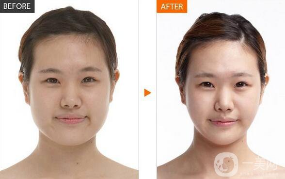 北京顴骨手術(shù)要多少錢？