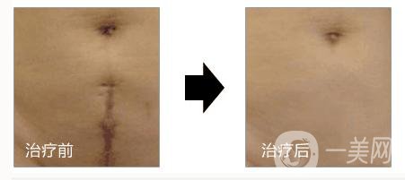 上海做一次像素激光去疤痕手術調節(jié)多少錢