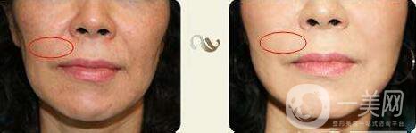 熱瑪吉,去法令紋,*果,原理