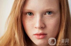 黃褐斑能用激光去除嗎？