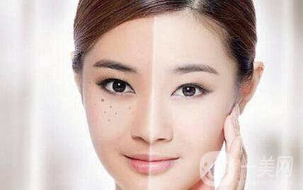 黃褐斑能用激光去除嗎？