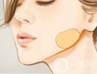 去頰脂墊瘦臉價格要多少錢？