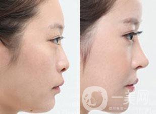 廣東*整形手術(shù)一般要多少錢(qián)