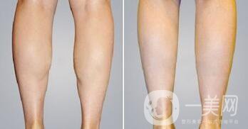 南京光纖溶脂瘦小腿價(jià)格是多少