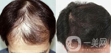 鄭州植發(fā)醫(yī)院信息介紹？植發(fā)去介紹