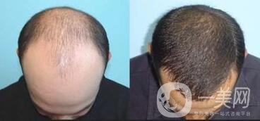 鄭州植發(fā)醫(yī)院信息介紹？植發(fā)去介紹