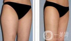 吸脂*嗎？吸脂手術(shù)有風(fēng)險(xiǎn)嗎