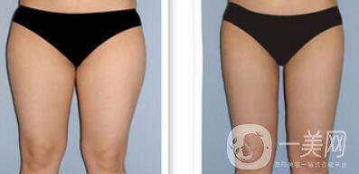 吸脂*嗎？吸脂手術(shù)有風(fēng)險(xiǎn)嗎