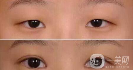 開眼角割雙眼皮整形手術(shù)*果怎么樣