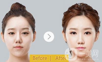 注射**有副作用嗎