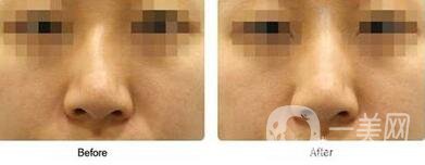 歪鼻矯正需要恢復(fù)多久？術(shù)后需要注意什么