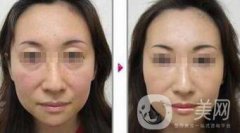 小切口面部提升果怎么樣？會(huì)不會(huì)留疤