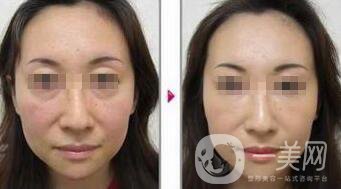 小切口面部提升*果怎么樣？會不會留疤