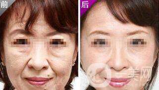 小切口面部提升*果怎么樣？會不會留疤