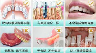 種植牙后要注意什么 種植牙還您一口漂亮的牙齒