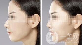 墊下巴用什么材料好？墊下巴改良臉型*果