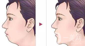 墊下巴用什么材料好？墊下巴改良臉型*果