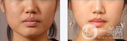 墊下巴用什么材料好？墊下巴改良臉型*果