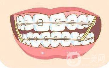 t4a矯正牙齒,怎么樣