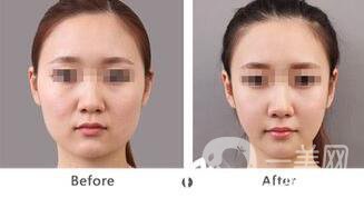 北京哪里吸脂好？吸脂手術會反彈嗎