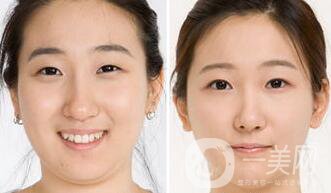 北京哪里吸脂好？吸脂手術會反彈嗎