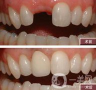 種植牙有什么優(yōu)點？北京種植牙介紹?