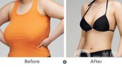 巨乳縮小術(shù)要多久可以恢復(fù)