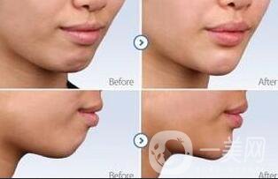 上海玻尿酸墊下巴多少錢