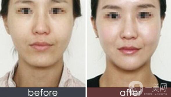 上海玻尿酸墊下巴多少錢