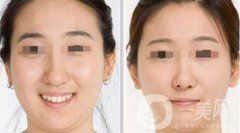 激光溶脂和吸脂的區(qū)別都有什么