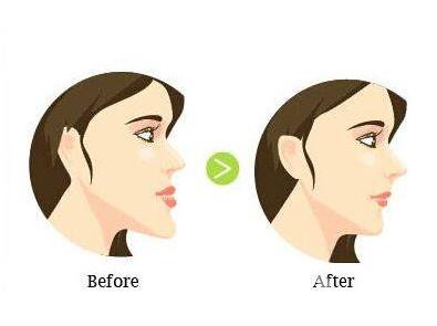 地包天,廣東地包天整形,廣東地包天整形多少錢,地包天矯正價格分析