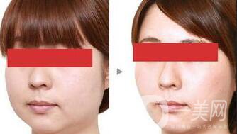 激光溶脂和吸脂的區(qū)別都有什么