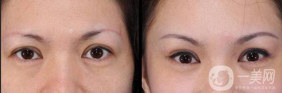 廣東切眉整形手術(shù)多少錢