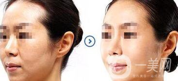 拉皮手術(shù)的方法有哪些?成都拉皮手術(shù)一般多少錢