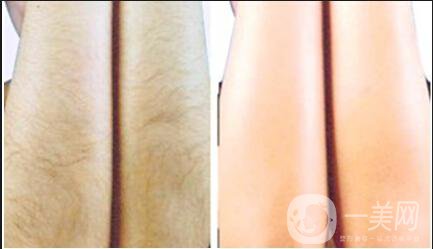 北京激光脫毛費(fèi)用介紹 價(jià)格詳情