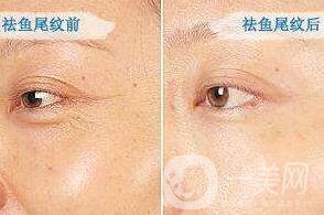 深圳魚尾紋打玻尿酸,深圳魚尾紋打玻尿酸要多少錢
