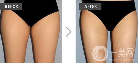 光纖溶脂,光纖溶脂*果,光纖溶脂副作用