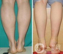 射頻瘦小腿保持多久?纖細(xì)雙腿不是夢美
