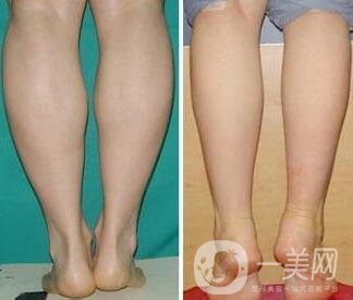 射頻瘦小腿保持多久?纖細(xì)雙腿不是夢(mèng)美
