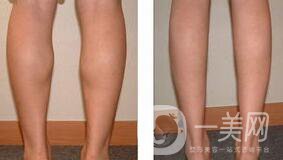 射頻瘦小腿保持多久?纖細(xì)雙腿不是夢(mèng)美