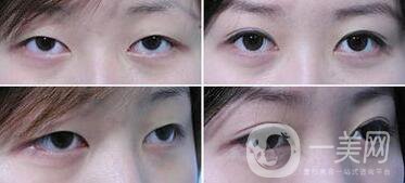 重慶割雙眼皮需要花多少錢(qián)呢