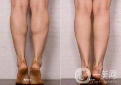 瘦小腿手術(shù)是怎么樣的？具體方法有哪些