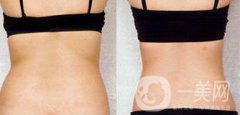 后背吸脂后多久消腫？吸脂術(shù)后如何護(hù)理