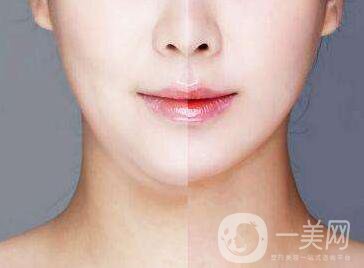 雙下巴吸脂多少錢？價格盤點！