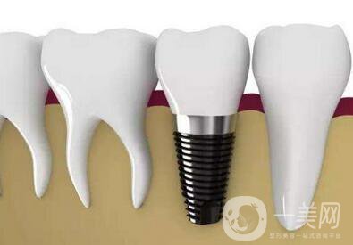 浙江種植牙一顆一般多少錢